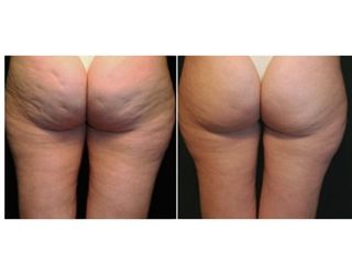 Mesoterapia e intralipoterapia prima dopo