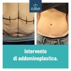 Addominoplastica - Clisur- Clinical & Surgery