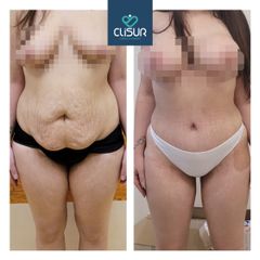 Addominoplastica - Clisur- Clinical & Surgery