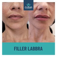 Filler labbra  - Clisur- Clinical & Surgery