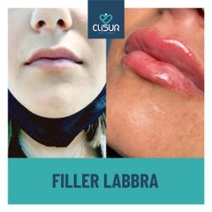 Filler labbra  - Clisur- Clinical & Surgery