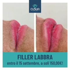 Filler labbra  - Clisur- Clinical & Surgery