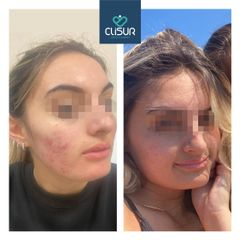 Acne - Clisur- Clinical & Surgery