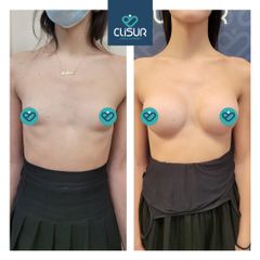 Mastoplastica additiva - Clisur- Clinical & Surgery