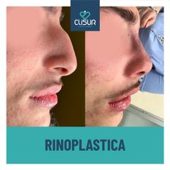 Rinoplastica - Clisur- Clinical & Surgery