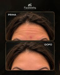 Facestetiq Marsala post botox prima e dopo