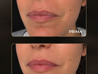 Filler labbra prima e dopo - 881441