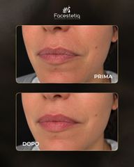 Facestetiq Marsala Filler Labbra