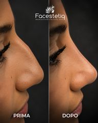 Facestetiq Marsala Rinofiller