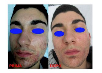 Trattamento Acne prima dopo