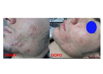 Trattamento Acne prima dopo