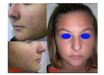 Trattamento Acne prima dopo