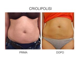 Criolipolisi prima e dopo
