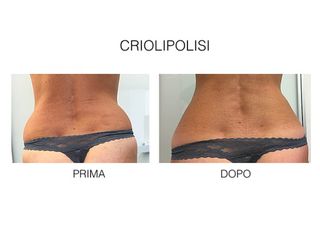 Criolipolisi prima e dopo