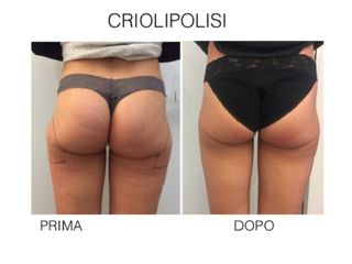 Criolipolisi prima e dopo