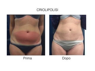 Criolipolisi prima e dopo