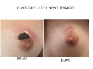 Nevo dermico prima e dopo