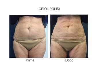 Criolipolisi prima e dopo