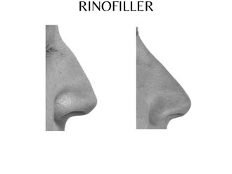Rinofiller - 865886