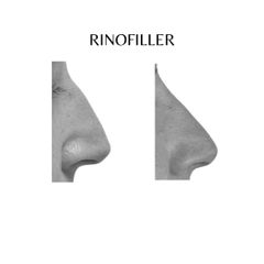 Correzione profilo nasale - Dott. Riccardo Favero