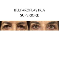 Blefaroplastica superiore - Dott. Riccardo Favero