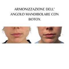 Botox profilo mandibolare - Dott. Riccardo Favero