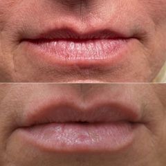 Prof. Vittorio Favero Simmetrizzazione e volumizzazione labbra