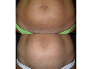 Smagliature addome prima e dopo