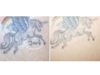 Rimozione tatuaggio prima e dopo