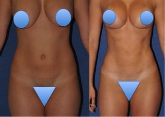 Mastopessi con protesi e liposcultura prima dopo
