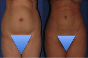 Liposcultura prima dopo
