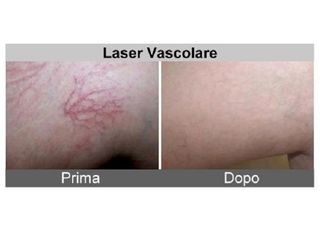 Laser vascolare prima e dopo