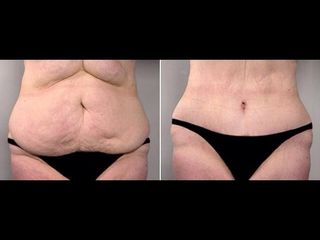 Liposuzione ed Addominoplastica prima e dopo