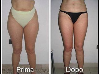 Liposuzione prima e dopo