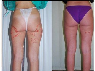 Liposuzione prima e dopo