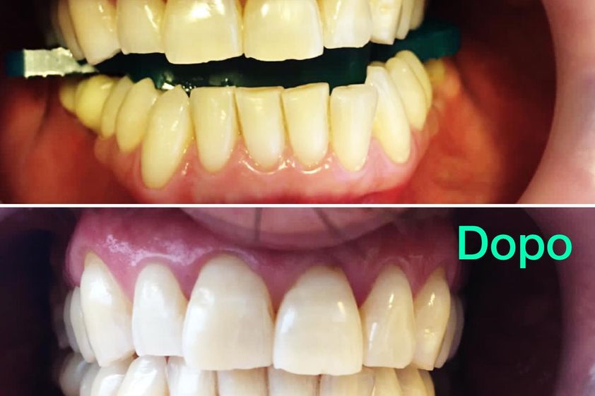 Sbiancamento denti prima e dopo - 800893