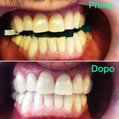 Sbiancamento denti - Dr. Bosio Roberto