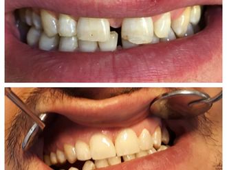 Faccette dentali - 807798