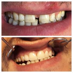 Faccette dentali - Dr. Bosio Roberto
