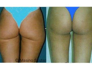 Liposuzione prima e dopo