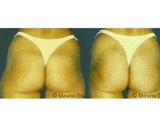 Glutei prima e dopo