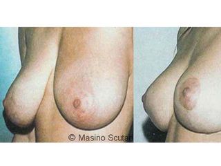 Mastopessi prima e dopo