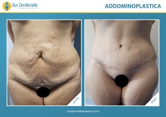 Addominoplastica prima dopo