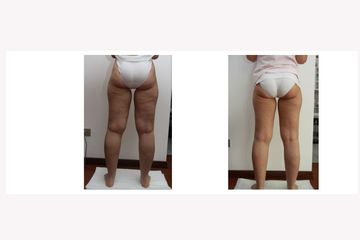 Carbossiterapia arti inferiori per cellulite
