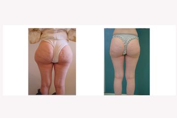 Liposuzione prima e dopo
