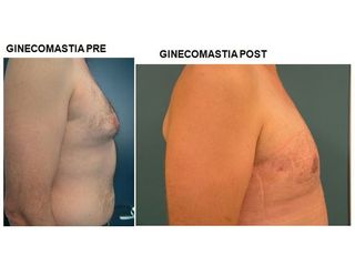 Ginecomastia prima e dopo