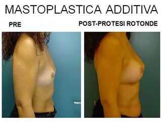 Mastoplastica additiva prima e dopo