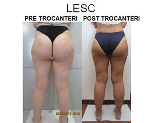 Lesc prima e dopo
