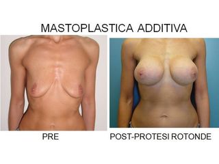 Mastoplastica additiva prima e dopo