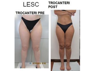 Lesc prima e dopo